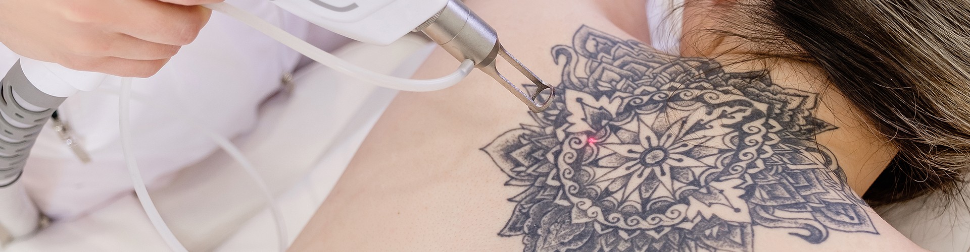 Laser Tattoo Removal