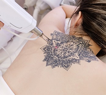 Laser Tattoo Removal