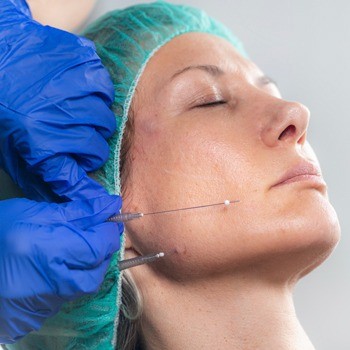 Skin Threads (Non-Surgical Skin Tightening & Collagen Stimulation)